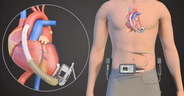 打破国外技术垄断 国产全磁悬浮式人工心脏已获批上市